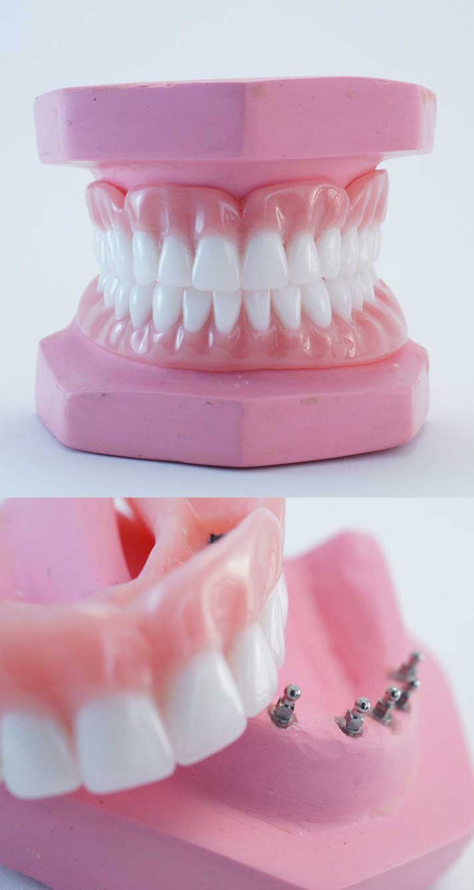 snap dentures denture dental palate taste affected frequently patients sense regular wear report